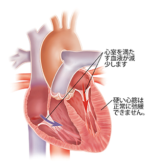 拡張期心不全のある心臓の断面図。