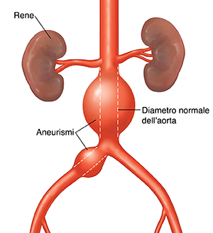 Vista frontale dell’aorta addominale con aneurismi. La linea tratteggiata indica il diametro normale dell'aorta.