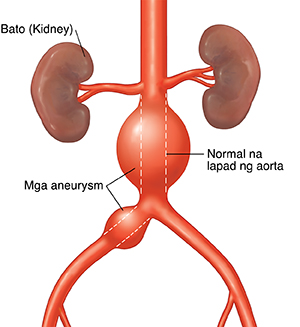 Harapang kuha ng abdominal aorta na may mga aneurysm. Ipinakikita ng mga dotted line ang normal na lapad ng aorta.