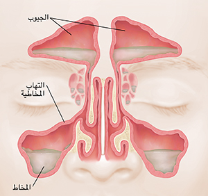 صورة أمامية للجيوب الأنفية تُظهر مخاطًا وبطانة حمراء ومتورمة.