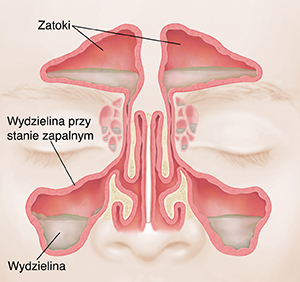 Widok zatok od przodu pokazujący zaczerwienioną, obrzękniętą błonę śluzową i wydzielinę.