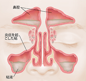 赤く腫れた内壁と粘液を示す副鼻腔の正面図。