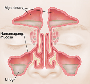 Harap na larawan ng mga sinus na ipinapakita ang mapula at namamagang lining at mucus.