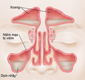 Mặt trước của xoang cho thấy niêm mạc đỏ, sưng và chất nhầy.