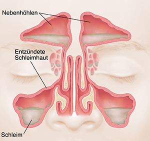 Vorderansicht von Nasennebenhöhlen mit geröteter, geschwollener Schleimhaut und Schleim.