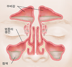 내벽이 빨갛게 부어오르고 점액이 찬 모습이 보이는 부비강의 전면 모습.