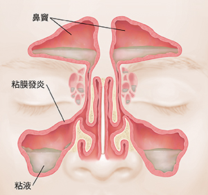 鼻竇正面圖,顯示紅色腫脹的內壁和粘液。