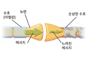 뉴런 2개가 만나는 시냅스의 근접 모습. 화살표는 메시지가 건강한 뉴런을 통해 이동하고, 손상된 뉴런에서 올바로 전달되지 않는 모습을 보여줍니다.
