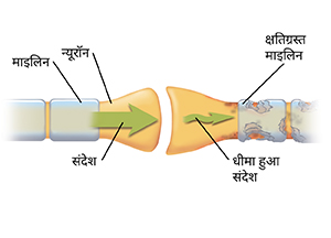 सिनैप्स का क्लोज़अप जहाँ दो न्यूरॉन्स मिलते हैं। स्वस्थ न्यूरॉन के माध्यम से संदेश को चलने और क्षतिग्रस्त न्यूरॉन में बाधित होने को दर्शाते हुए तीर।