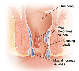 Cross section ng tumbong at puwit na ipinapakita ang mga almoranas.