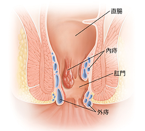 顯示痔瘡的直腸和肛門的橫截面圖。