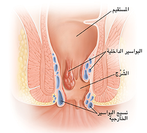 مقطع عرضي للمستقيم والشرج يعرض البواسير.