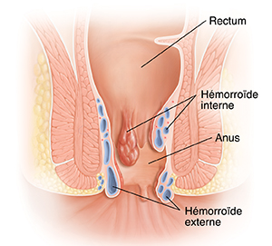 Coupe transversale d'un rectum et d'un anus normaux souffrant d'hémorroïdes.