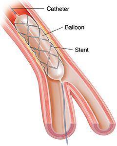 Cross section ng arterya na ipinakikita ang paglalagay ng stent gamit ang balloon catheter.