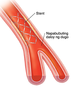Cross section ng arterya na ipinakikita ang pagdaloy ng dugo sa loob ng stent.