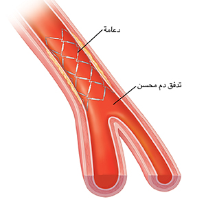 مقطع عرضي لشريان يُظهر تدفق الدم خلال الدعامة.