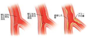 内壁の正常な血圧を示す矢印の付いた動脈の断面図。内壁の高血圧を示す矢印の付いた動脈の断面図。損傷した内壁とプラークの蓄積を示す動脈の断面図。