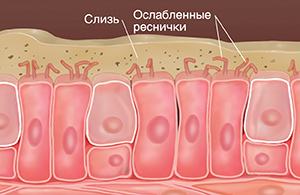Клетки с поврежденными ворсинками, в которых наблюдаются скопления слизи и накопление в ней различных частиц.