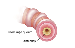 Mặt cắt ngang của nhánh cuống phổi nhỏ cho thấy đường thở hầu hết bị tắc nghẽn do chất nhầy, viêm và co thắt cơ.
