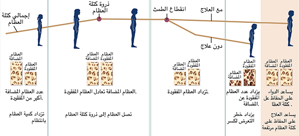 رسم بياني يُوضح نمو العظام وفقدانها على مدى حياة المرأة، مع أو بدون تناول علاج لهشاشة العظام.