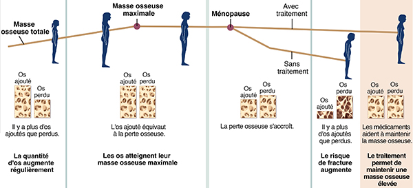 Un graphique montrant la croissance et la perte osseuse au cours de la vie d'une femme, avec et sans traitement contre l'ostéoporose.