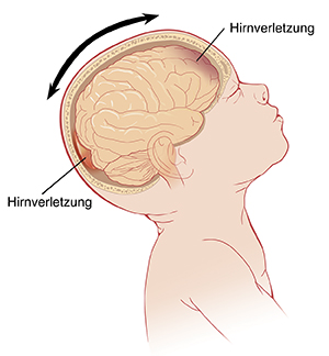 Seitenansicht eines Babys mit nach hinten geneigtem Kopf mit schematischer Darstellung des Gehirns. Die Pfeile zeigen den Kopf, der sich vor und zurückbewegt, und Verletzungen an der Vorder- und Hinterseite des Gehirns.