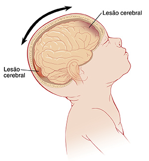 Vista lateral de um bebê com a cabeça para trás mostrando o cérebro dentro. Setas mostrando a cabeça indo para a frente e para trás, e lesões na frente e atrás do cérebro.