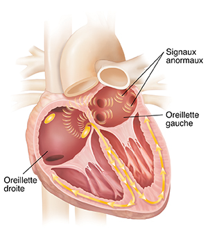 Coupe transversale d'un cœur montrant une fibrillation atriale.