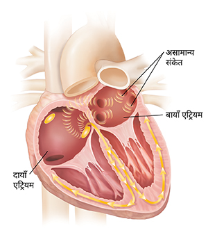 एट्रियल फिब्रिलेशन को दर्शाता हुआ दिल का क्रॉस सेक्शन।