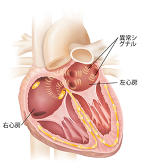 心房細動を示す心臓の断面。