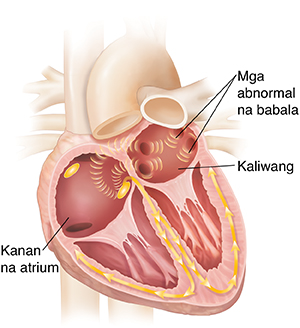 Cross section ng puso na ipinakikita ang atrial fibrillation.
