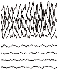 부분 발작 EEG 추적.