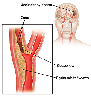Skrzep krwi blokujący tętnicę szyjną i zator rozrywający skrzep. Zbliżenie pokazuje uszkodzenie mózgu.