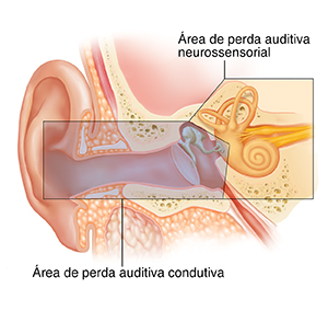 Corte transversal da orelha mostrando as estruturas da orelha externa, interna e média. A sobreposição de cores mostra áreas que causam perda auditiva condutiva e neurossensorial.