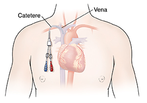 Profilo del torace di un uomo in cui è inserito un catetere cardiaco.