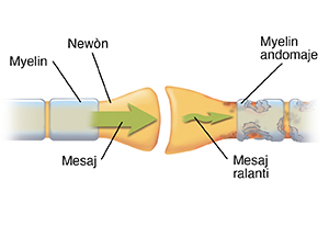 Yon gwo plan sou sinaps la kote de newòn kwaze. Flèch yo moutre yon mesaj ki ap avanse nan yon newòn ki an sante epi li gaye nan yon newòn ki domaje.