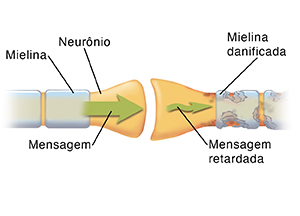 Vista aproximada de sinapse onde dois neurônios se encontram. As setas mostram a mensagem se movendo através do neurônio saudável e sendo interrompida no neurônio danificado.