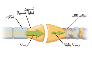 صورة مقرّبة للتشابك حيث تلتقي خليتان من الخلايا العصبية. تُظهر الأسهم رسالة عندما تتحرك عبر خلايا عصبية سليمة وتتعطل عند مرورها بخلايا عصبية مصابة.