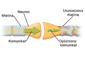 Zbliżenie synapsy, gdzie spotykają się dwa neurony. Strzałki wskazują komunikat przenoszony przez zdrowy neuron i rozpadający się przez uszkodzony neuron.