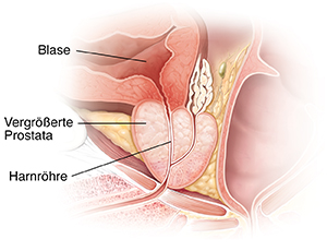 Querschnitt einer vergrößerten Prostata.