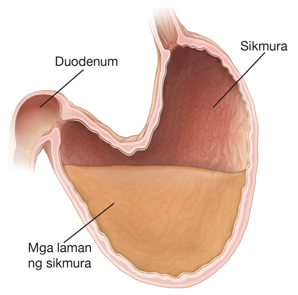 Cross seksyon ng sikmura at duodenum. Ang sikmura ay malaki at lundo. Ang mga nilalaman ng sikmura sa lundong bahagi ay hindi mailipat nang maayos palabas ng tiyan patungo sa duodenum.