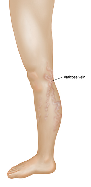Gilid na kuha ng binti na ipinakikita ang mga varicose vein.